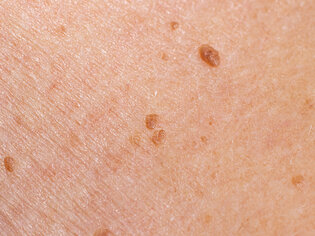Papilómy: Výrastky na koži a spôsoby ako ich odstrániť