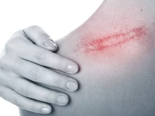 Keloidná jazva