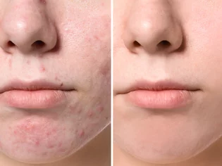 Moderné metódy na liečbu akné
