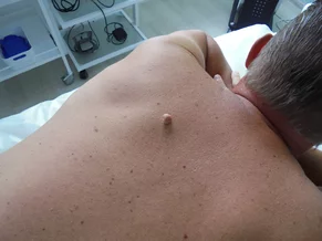 Odstránenie fibrómu PRED