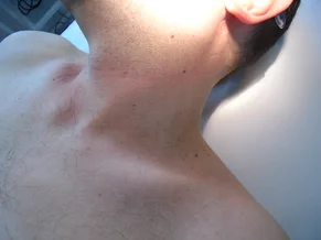 Odstránenie kožných výrastkov PRED